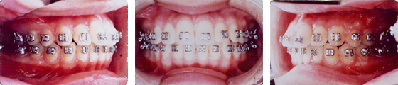治療経過を見て、抜歯・非抜歯の治療を検討